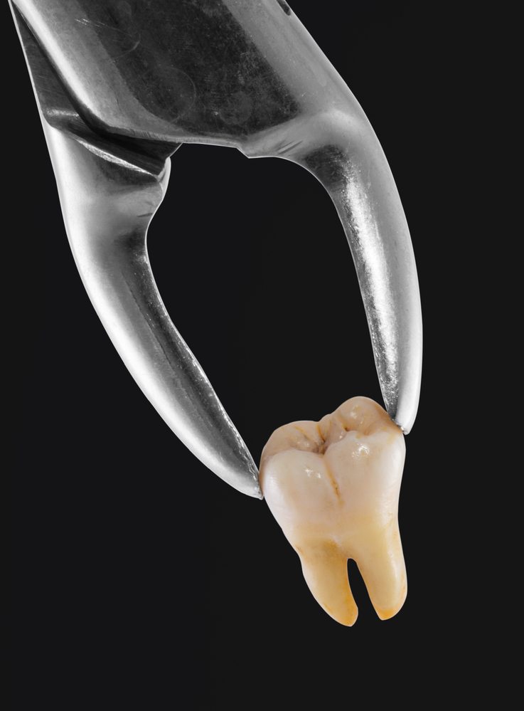 Image result for extraction tooth