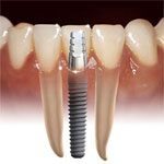 dental implants bedford