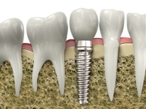 dental implants Bedford