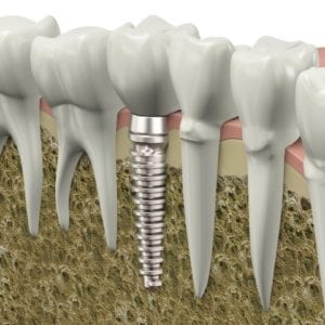 tooth implant North Richland Hills