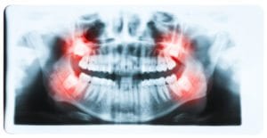 x-ray to prepare for wisdom teeth removal
