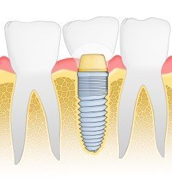 Reclaim a More Youthful Appearance with Dental Implants