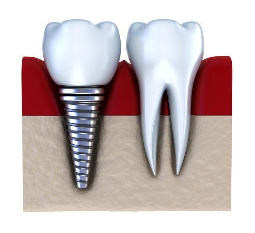 How Dental Implants can Reduce Long-term Dental Costs