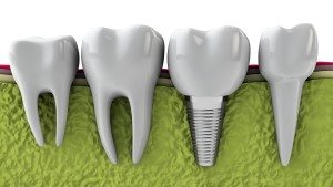 Which Teeth Can Be Replaced by Dental Implants?