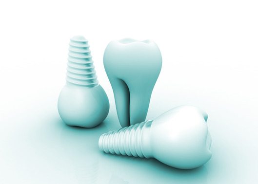 dental-implant-picture
