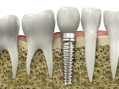 dental-implant-demonstration