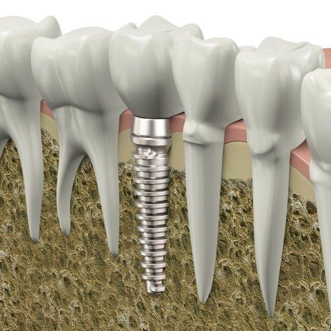 tooth-implant-graphic