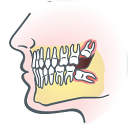 impacted wisdom tooth graphic