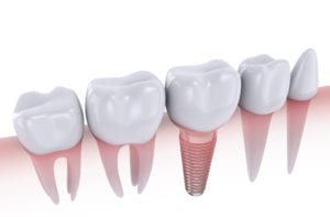 What is the cost of dental implants in Colleyville TX ?