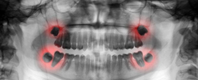 panoramic dental x-ray highlighting problematic wisdom teeth