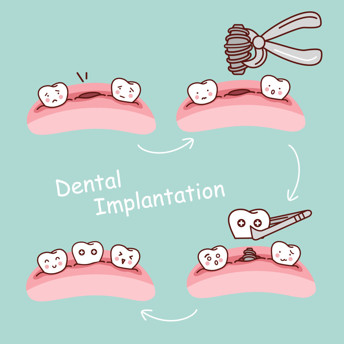 What To Expect With Dental Implant Surgery: Before, During, And After ...