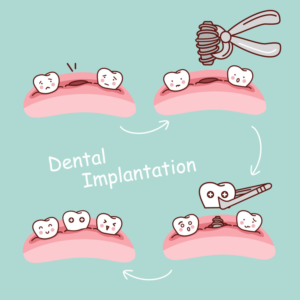 dental implant surgery process