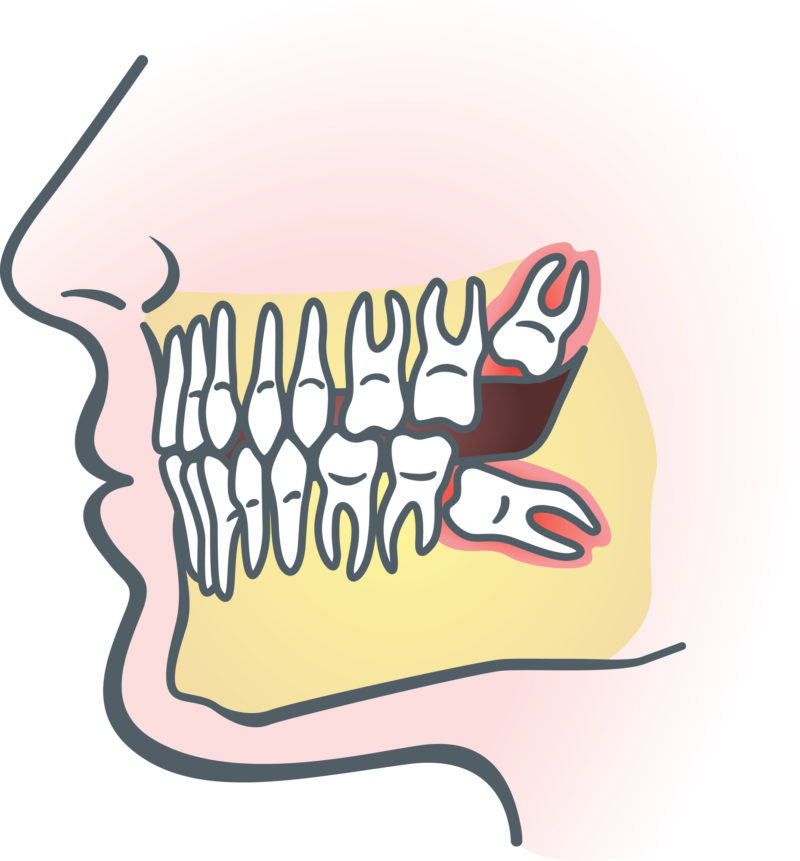 Who removes wisdom teeth