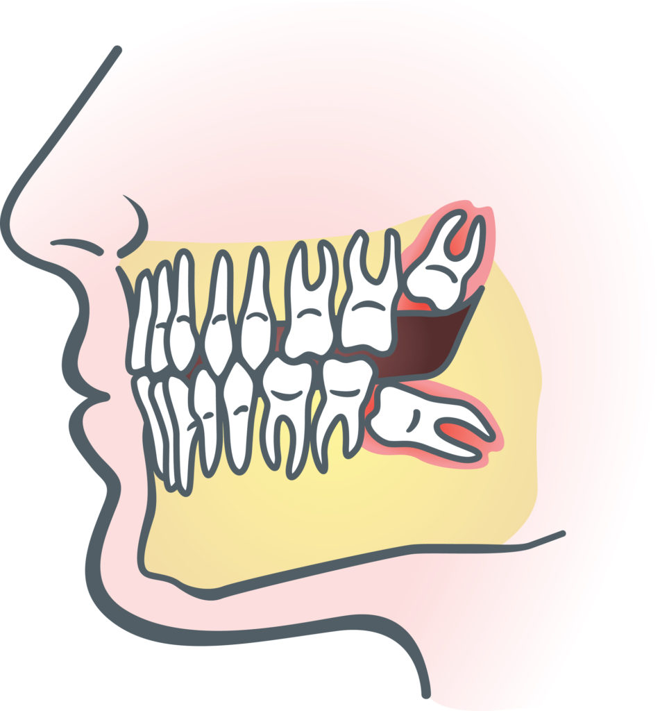 picture of wisdom teeth