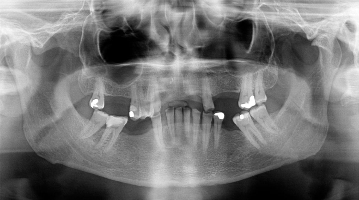 x-ray of mouth with missing teeth