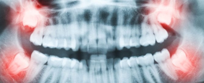 image of wisdom teeth x-ray