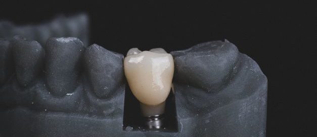 model of implant dental