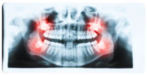 An x-ray image of the mouth with red highlights showing where a wisdom tooth infection could occur
