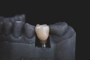 3-D jaw model with dental implants