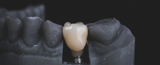 3-D jaw model with dental implants
