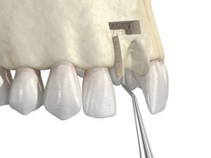 3D illustration of dental bone grafting