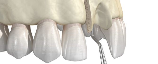 3D illustration of dental bone grafting