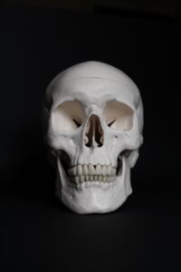 A skull demonstrates where dental bone grafting takes place