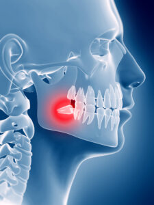 x-ray of head and neck with impacted wisdom teeth
