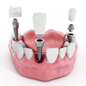 Illustration of teeth showing dental implants