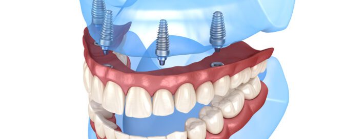 Maxillary and Mandibular prosthesis with gum All on 4 system supported by implants. Medically accurate 3D illustration of human teeth and dentures