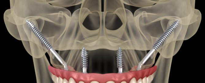 zygomatic implants